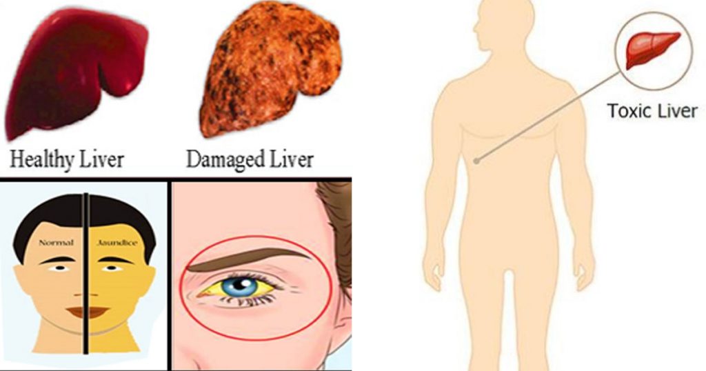 12-Signs-to-watch-out-for-Liver-Damage-1